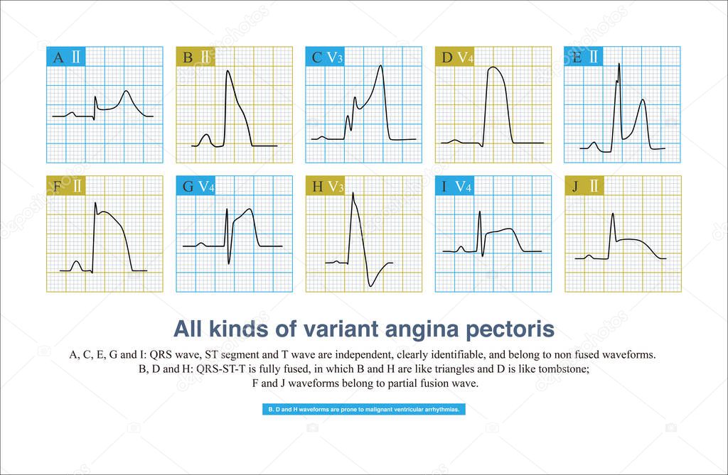 During the onset of variant angina pectoris, ECG is divided into non fusion wave, partial fusion wave and complete fusion wave according to the fusion degree of QRS wave, ST segment and T wave.