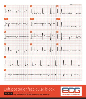 During left posterior fascicular block, the ECG showed right axis deviation. The QRS wave in leads I and aVL was rS wave, and the duration of QRS wave was less than 120 ms.