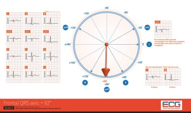 During posterior fascicular block, the frontal electrical axis deviated to the right, and the QRS wave of leads  and aVL showed rS wave.Other reasons for the right axis deviation must be ruled out.