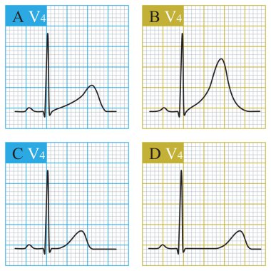 A is infantile type, short ST segment, fast fusion with T wave; B is a wide basal T wave; C is normal type; D is late onset normal type, ST segment is prolonged and T wave morphology is normal.