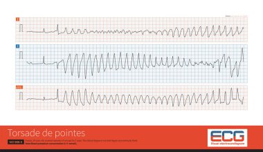 Torsade de pointes refers to the pleomorphic ventricular tachycardia that occurs in the background of long QT interval, and the polarity of QRS wave twists around the equipotential line.
