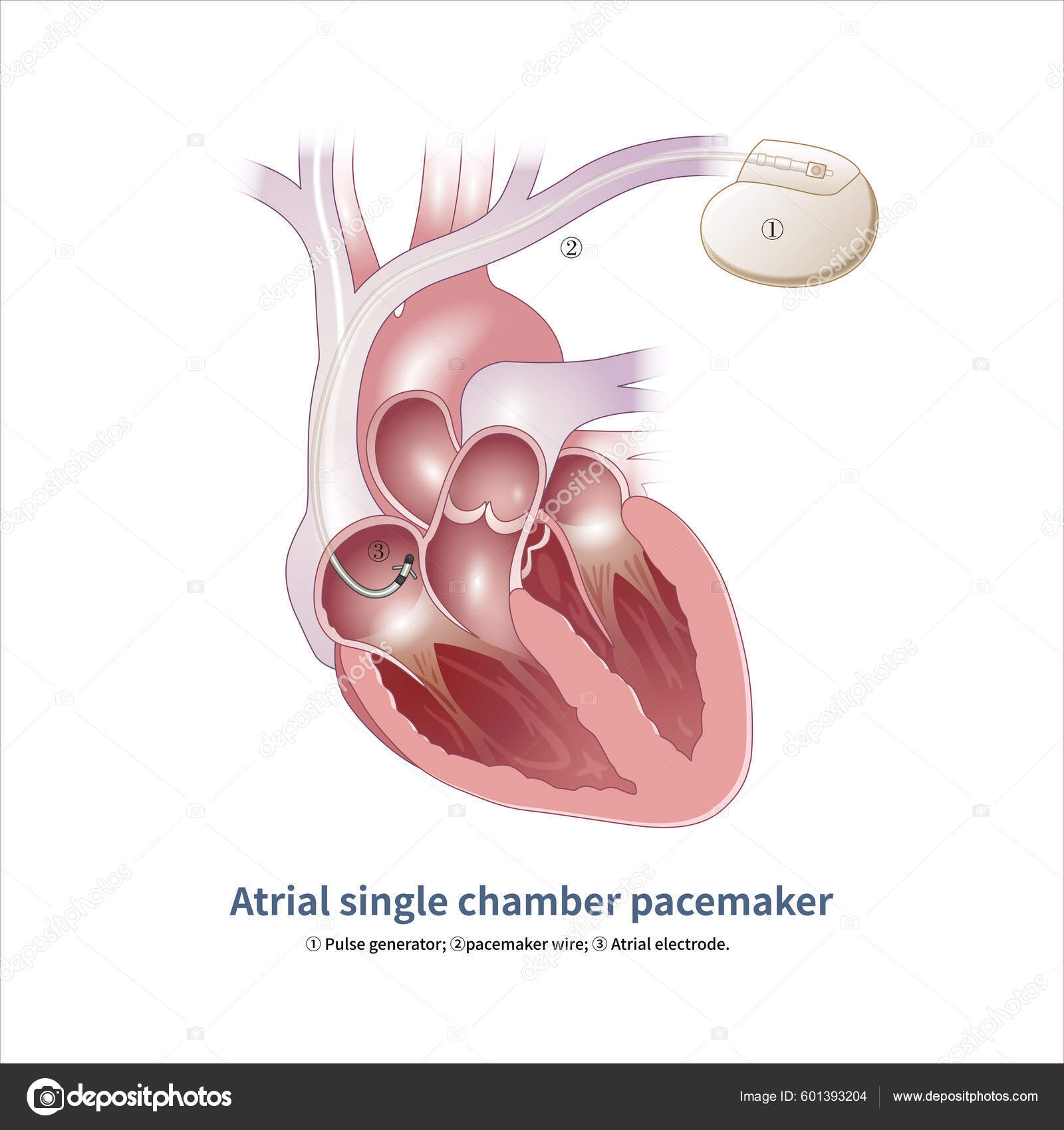 Atrial Single Chamber Pacemakers Have Only One Electrode Placed Atrium ...
