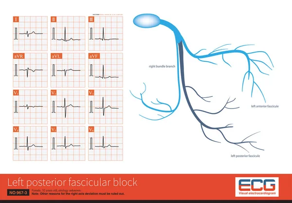 During left posterior fascicular block, the ECG showed right axis deviation. The QRS wave in leads I and aVL was rS wave, and the duration of QRS wave was less than 120 ms.