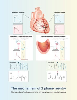 In the early stage of acute transmural myocardial ischemia, the mechanism of ventricular arrhythmia is mainly 2 phase reentry, including reentry between ischemic and non ischemic areas and reentry across the ventricular wall.