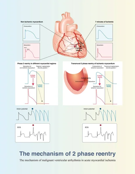 Early Stage Acute Transmural Myocardial Ischemia Mechanism Ventricular Arrhythmia Mainly — Foto de Stock