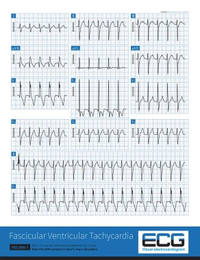 A fascicular ventricular tachycardia is an idiopathic ventricular tachycardia that originates in the left fascicular region, in this case the left posterior fascicular region.