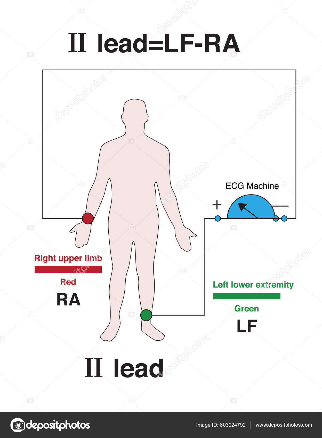 Positive Electrode Lead Electrocardiogram Placed Left Lower Extremity Negative Electrode