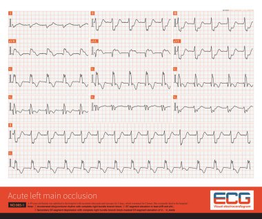 The coronary angiography showed complete occlusion of the left main artery, TIMI 0 and no stenosis in the right coronary artery with TIMI 3, and a lateral circulation to left coronary artery.