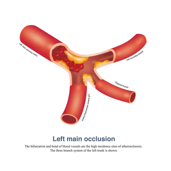 Left Main Artery Occlusion Most Serious Acute Coronary Syndrome Patients — Stok fotoğraf