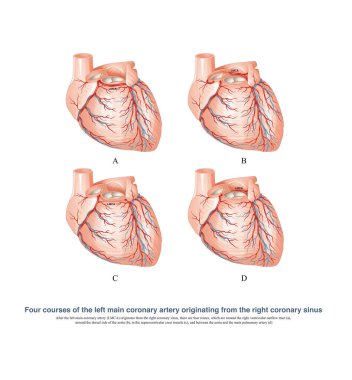 The abnormal left coronary artery originates from the right coronary sinus, and the abnormal course of blood vessels is the cause of sudden death of some patients during exercise.