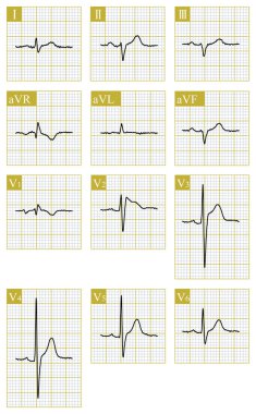 Male, 66 years old, received chemotherapy for esophageal cancer. Type II Brugada phenotype appearsed on ECG, which needs to be differentiated from primary Brugada syndrome.