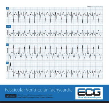 A fascicular ventricular tachycardia is an idiopathic ventricular tachycardia that originates in the left fascicular region, in this case the left posterior fascicular region.