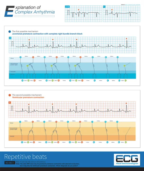 Ventricular Junctional Premature Contractions Can Activate Ventricle Again Reentry Mechanism — Fotografia de Stock