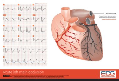 The coronary angiography showed complete occlusion of the left main artery, TIMI 0 and no stenosis in the right coronary artery with TIMI 3, and a lateral circulation to left coronary artery.