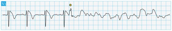 Egy Primer Brugada Szindrómában Szenvedő Betegnél Akinek Ekg Típusú Brugada — Stock Fotó