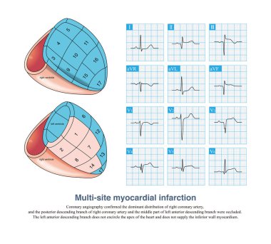 Erkek, 36 yaşında, 1 gün boyunca göğüs ağrısı şikayetiyle hastaneye yatırılmış. Troponin pozitif çıktı. Klinik teşhisi akut posterior inferior ve lateral miyokardiyal enfarktüs..