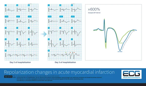 In acute myocardial infarction, the dynamic change of repolarization and prolongation of QT interval are the hallmarks of torsade de pointes.