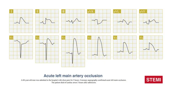 Acute left main artery occlusion can cause both ST segment elevation and non ST segment elevation myocardial infarction, regardless of which type, the risk of death is high.