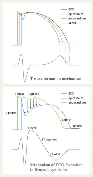 Механизм Синдрома Бругада Разница Фаз Реполяризации Между Эпикардом Эндокардом Потеря — стоковое фото