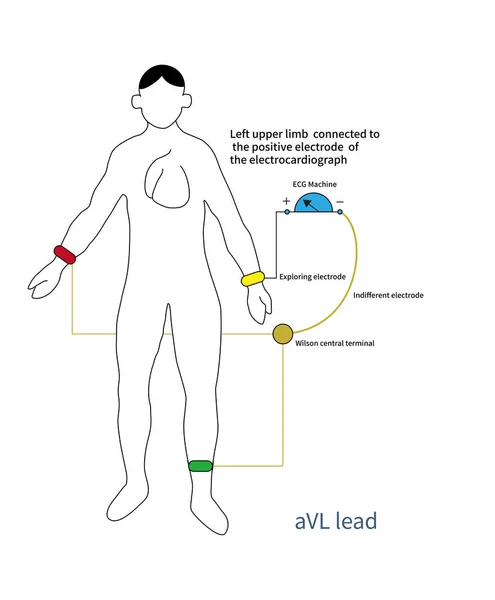 The positive pole of aVL lead is placed on the left upper limb, and the negative pole is an improved central terminal, which is actually a bipolar lead.