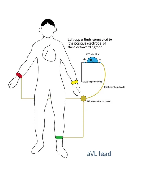 Положительный Полюс Свинца Avl Помещается Левую Верхнюю Конечность Отрицательный Полюс — стоковое фото