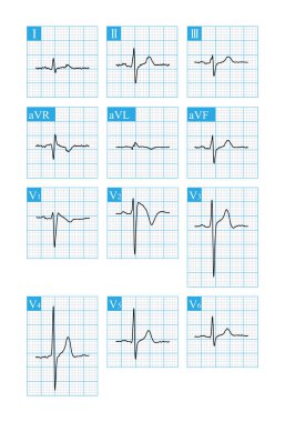 A 36 year old man survived CPR after sudden syncope. The electrocardiogram was suggestive of Brugada syndrome type 1. Implantation of ICD therapy. clipart