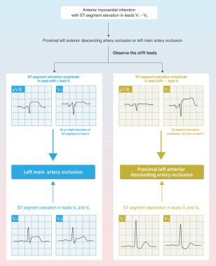 Akut anterior miyokardiyal enfarktüs durumunda, ECG 'deki ST segment yükselmesinin özellikleri, ana gövdenin sol gövdesi mi yoksa yakın LAD mi olduğunu anlamak için kullanılabilir..