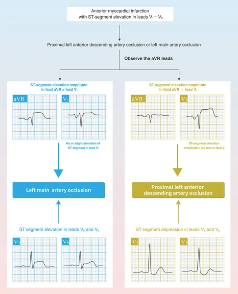 In case of acute anterior myocardial infarction, the characteristics of ST segment elevation in ECG can be used to deduce whether the culprit vessel system is the left main trunk or the proximal LAD.