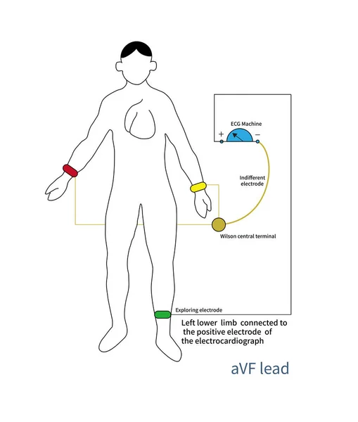 Положительный Полюс Свинца Avf Помещается Левую Нижнюю Конечность Отрицательный Полюс — стоковое фото