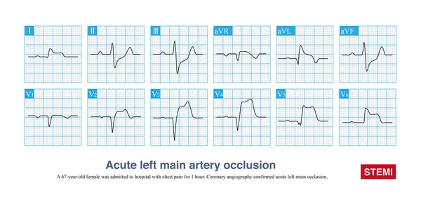 Akut Bal Artéria Elzáródás Szegmens Emelkedést Szegmens Emelkedés Nélküli Miokardiális — Stock Fotó