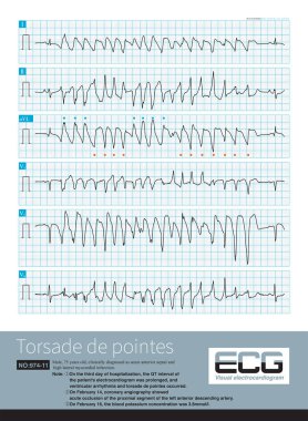 Torsade de Pointes 'in bir bölümünde, QRS kompleksinin polaritesi ECG' nin izoelektrik çizgisi etrafında tersine çevrilir..