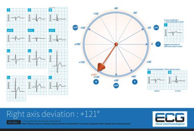 Elektrik ekseni sağa kaydığında, maksimum QRS vektörü sağ alt çeyrekte bulunur, bu da QRS dalga özellikleri ile kombinasyonda yorumlanabilir..
