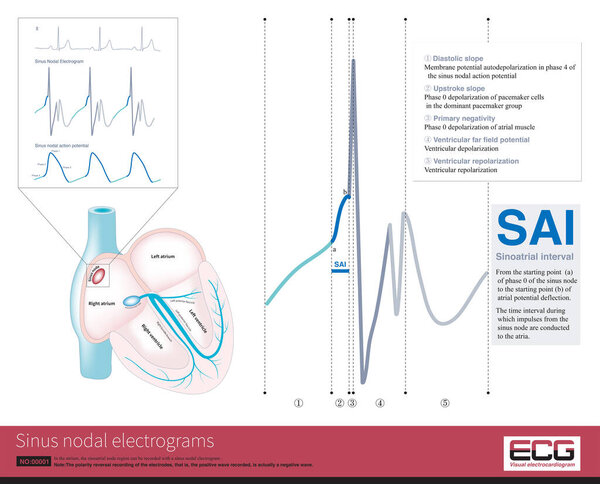Электрограмма синусового узла является методом записи электрической активности синусового узла инвазивным способом. График содержит потенциал деполяризации синусового узла и предсердия..