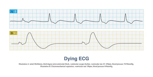 Electromechanical separation is an ECG of cardiac arrest. The heart has only electrical activity, but no mechanical activity. It needs to be differentiated from ventricular escape rhythm.