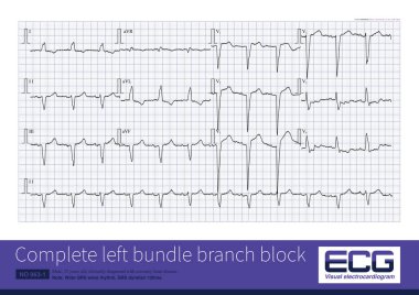 Sol bohça bloğunda, kurşun V1 'deki QRS dalgası genellikle rS ve QS morfolojilerinde, organik kalp hastalıklarında yaygın olarak görülen QRS süresi 120 metredir..
