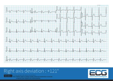 Elektrik ekseni sağa kaydığında, maksimum QRS vektörü sağ alt çeyrekte bulunur, bu da QRS dalga özellikleri ile kombinasyonda yorumlanabilir..