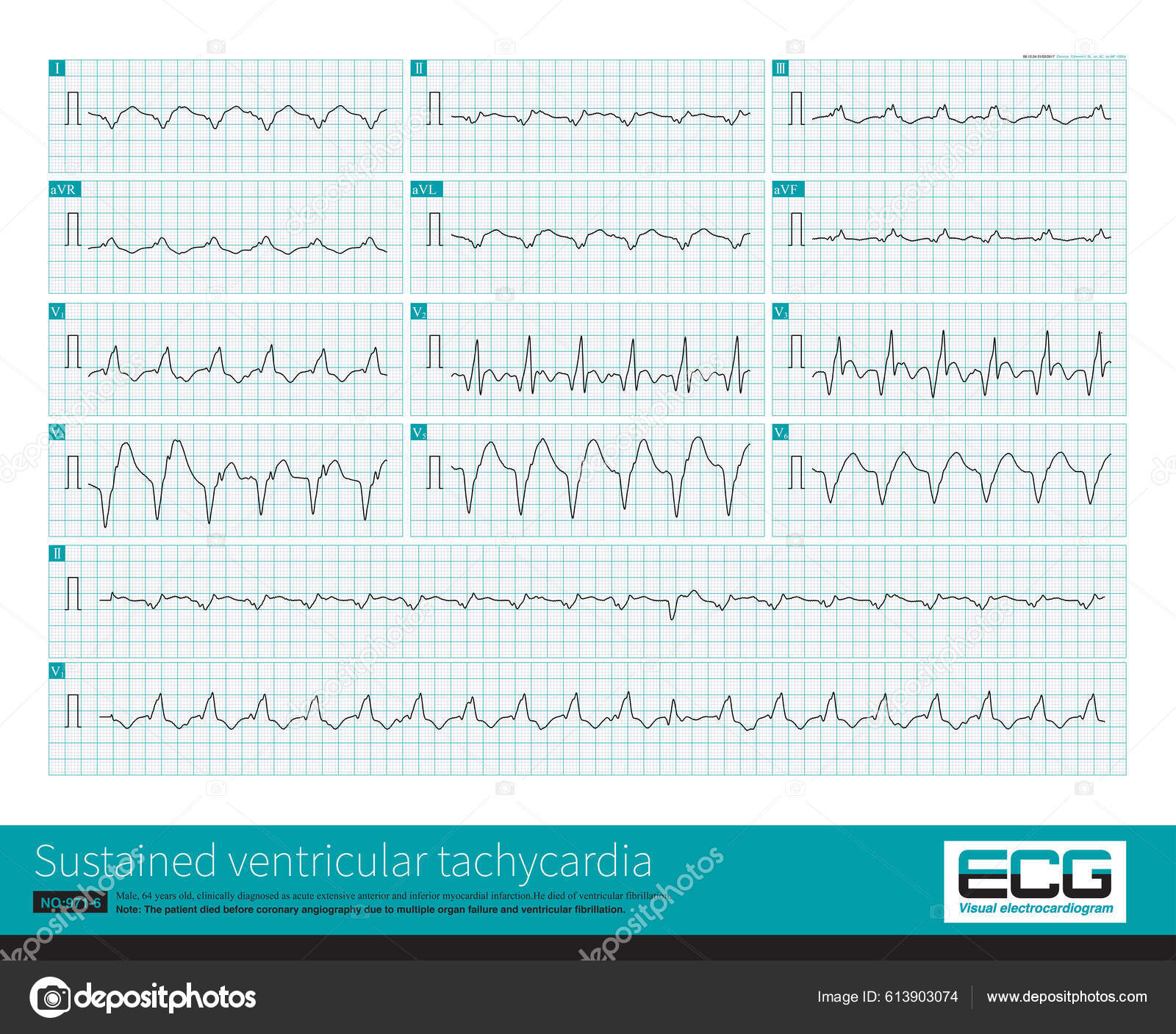 Ventricular Tachycardia Apple Watch Ecg Arrhythmia LOOKEE - Main Image