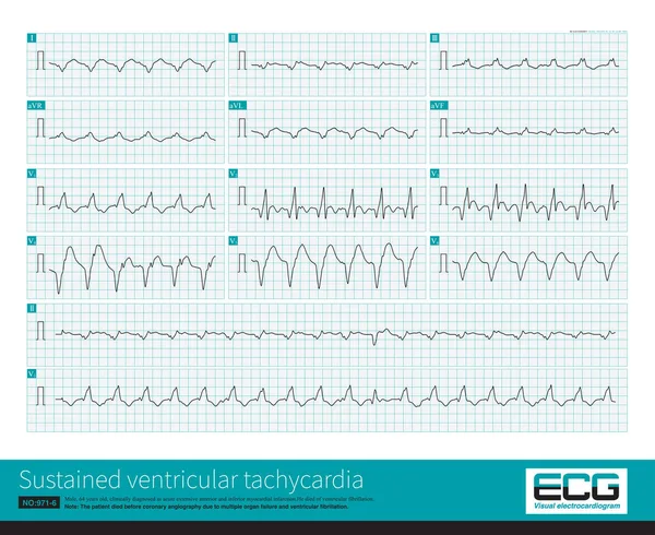 A patient with extensive anterior myocardial infarction had wide QRS wave tachycardia, that is, persistent ventricular tachycardia, with atrioventricular separation.
