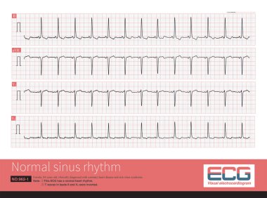 Genellikle, yetişkin sinüs ritminin normal frekansı 60 ile 100 bpm arasındadır, bu sinüs düğümü kalp pilinin normal fizyolojik voltaj frekansıdır..