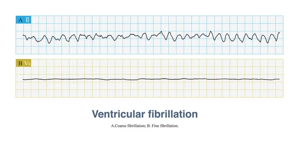 Ventricular fibrillation is a fatal arrhythmia and also a cardiac arrest rhythm. It can be divided into coarse fibrillation and fine fibrillation according to the amplitude of the fibrillation wave.