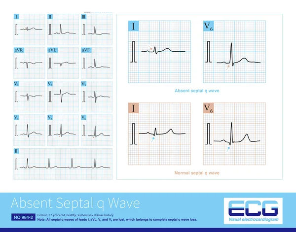 Onda Septal Ausente Ecg Pode Ser Uma Variante Normal Motivos — Fotografia de Stock