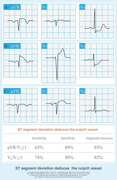 On ECG, in case of acute myocardial infarction, the ST segment deviation amplitude of some leads of ECG can be used to deduce culprit vessels.