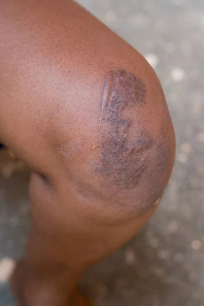 Healed knee of an african Nigerian person with scars markings gotten from an accident, medically treated in an hospital or clinic to prevent further damage to the leg and for better healthy living