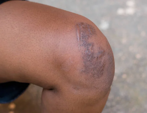 Healed knee of an african Nigerian person with scars markings gotten from an accident, medically treated in an hospital or clinic to prevent further damage to the leg and for better healthy living