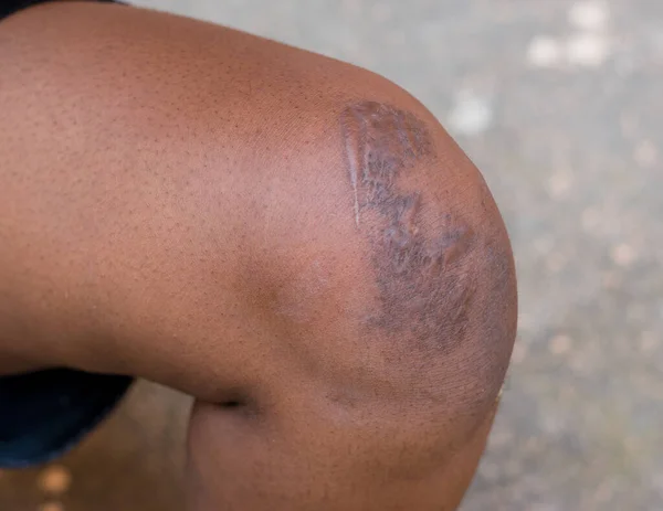 Kazadan kalma yara izleri olan Afrikalı bir Nijeryalı 'nın dizinin iyileşmesi, bacağa daha fazla zarar gelmesini önlemek ve daha sağlıklı bir yaşam için bir hastanede veya klinikte tedavi edilmesi.