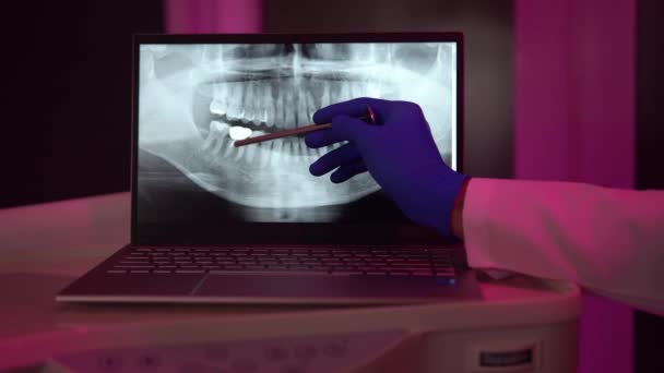 現代のクリニックの歯医者の椅子に座っている認識できない患者の肩の上に 切り取られた医師の手に歯科X線の画像を持つタブレットコンピュータを見て — ストック動画