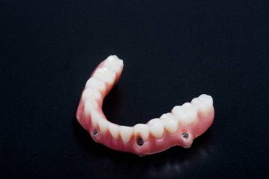 Bir fotoğraf stüdyosunda çekilen implant fotoğraflarıyla ilgili alt diş protezi işlemi tamamlandı.