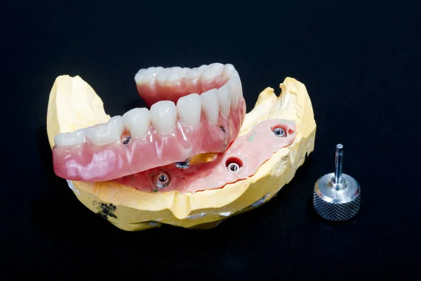 Complete Lower Dental Prosthesis Process Implants Photograph Taken Photographic Studio — Stock Photo, Image