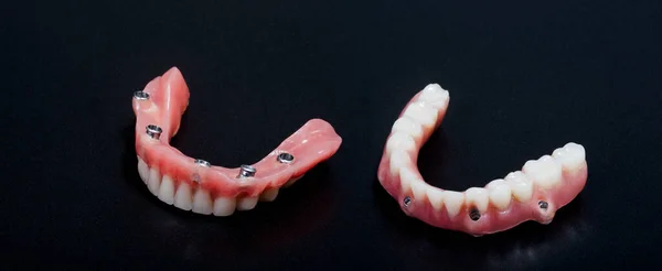 Complete Lower Dental Prosthesis Process Implants Photograph Taken Photographic Studio — Stock fotografie