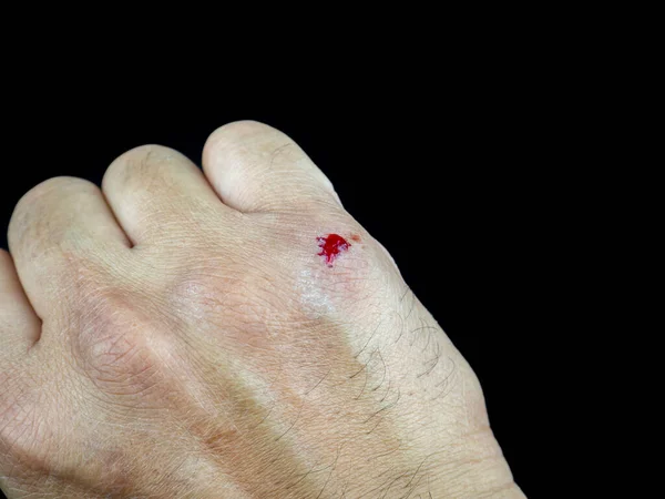 Accident Open Abrasion Wound Trauma Skin Hand People Healthcare Medicine — Foto de Stock